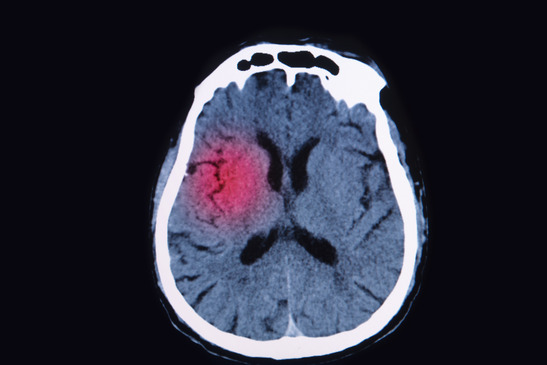 photodune-8326414-magnetic-resonance-image-mri-of-the-brain-show-brain-injury-xs.jpg